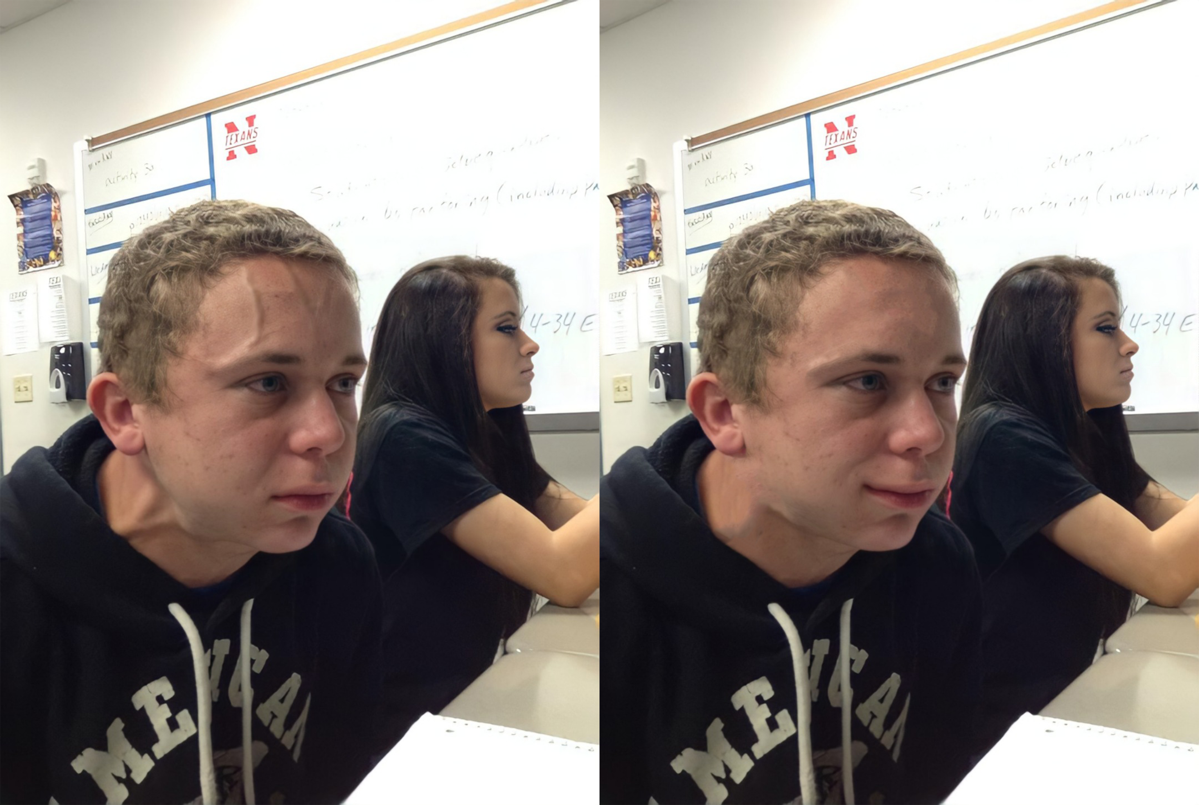 Variant forehead vein